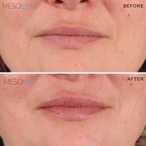 МезоЛифт За Обновяване на шията и да Пухлости устните В комбинация